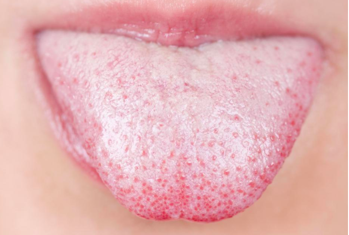 THIS is what a white tongue says about your health! Very few people know this!