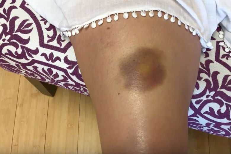 Five reasons why some people bruise so easily 