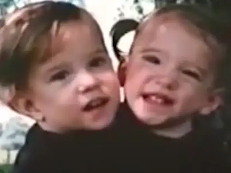 Years After These Siamese Twins Were Born, They Have Something To Share