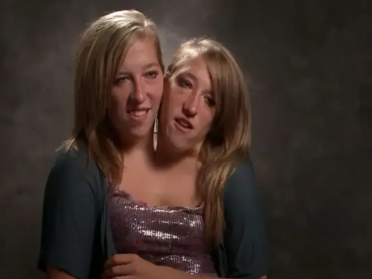 Years After These Siamese Twins Were Born, They Have Something To Share