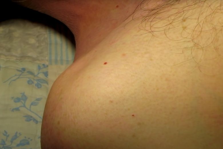 Dermatologists: This is how those red 'moles' can be removed