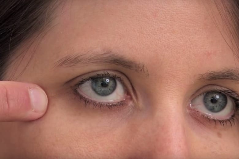 This trick can help you remove milia by yourself