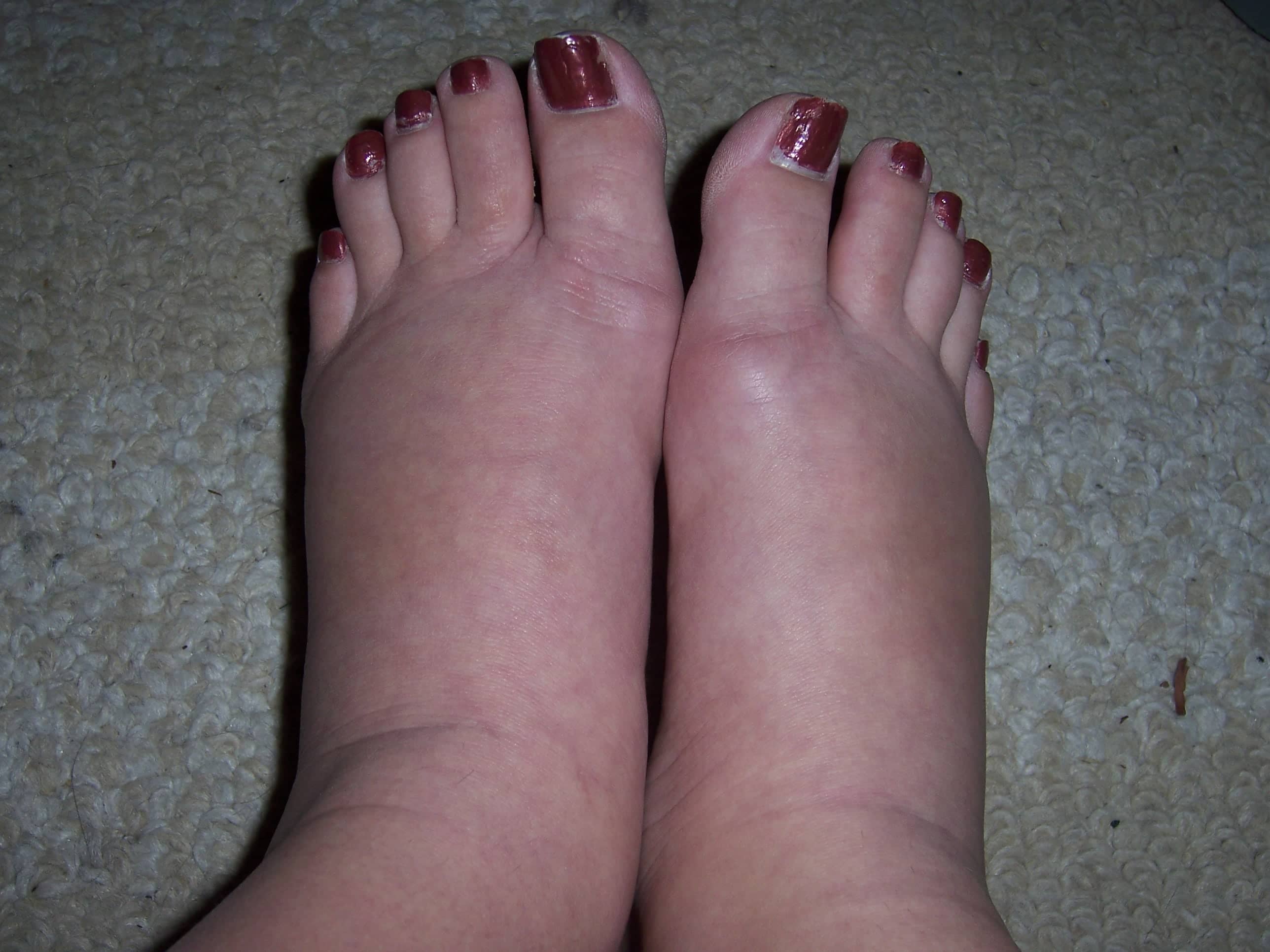 She retained a lot of water in her feet but that disappeared after following these 6 tricks!