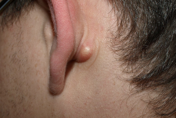 Do you sometimes have a strange little bump behind your ear? THIS is what it means!