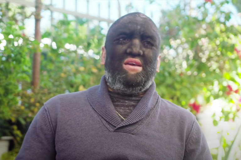 Hairiest family in the world shares shocking news