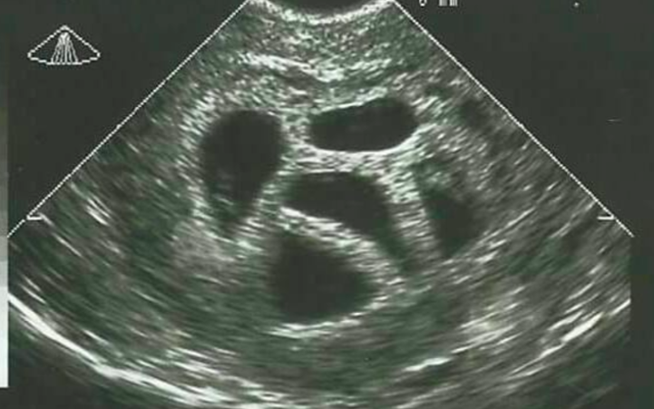 This mom refused to abort her quintuplets. Twenty years later, she shows this picture! Wow, this is amazing!