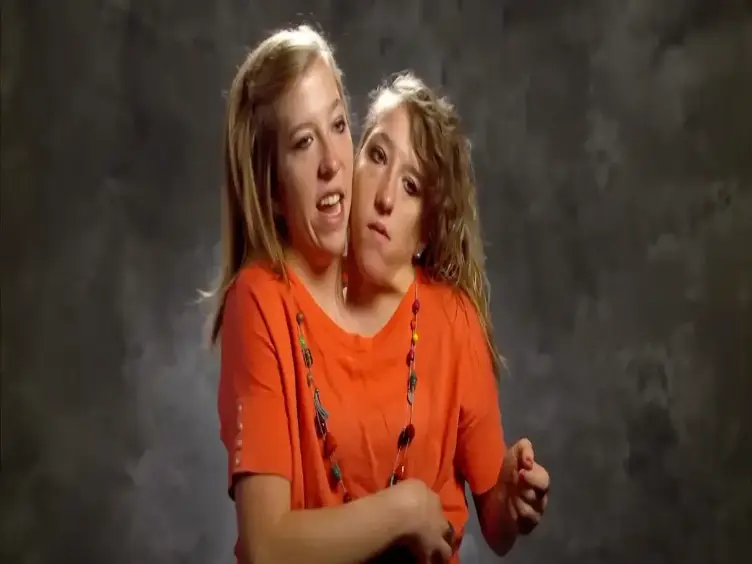 Years After These Siamese Twins Were Born, They Have Something To Share
