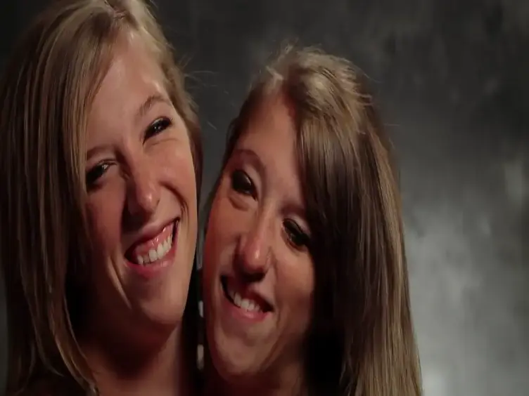 Years After These Siamese Twins Were Born, They Have Something To Share