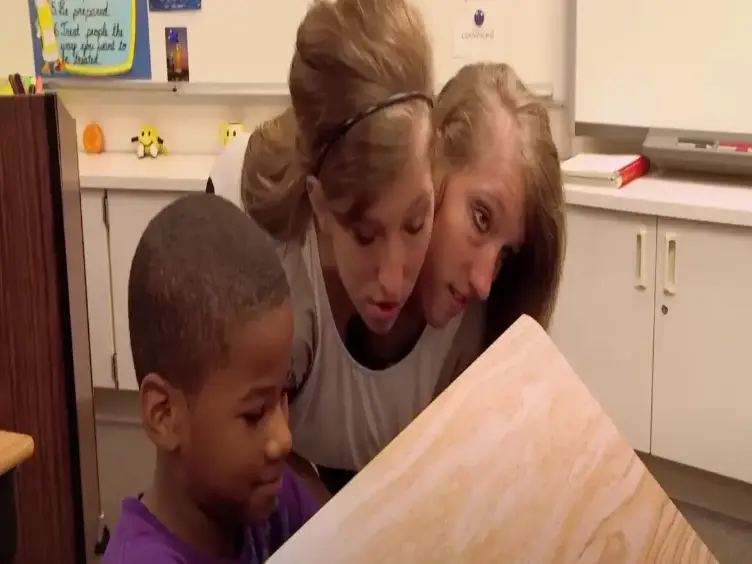 Years After These Siamese Twins Were Born, They Have Something To Share