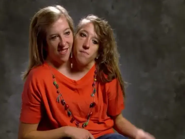 Years After These Siamese Twins Were Born, They Have Something To Share