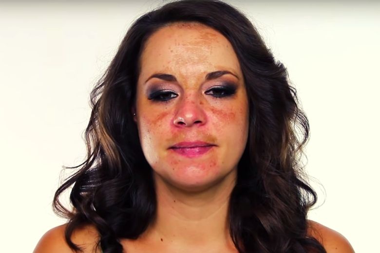 Pigment mustache: with these tips you can remove discoloration above the lip