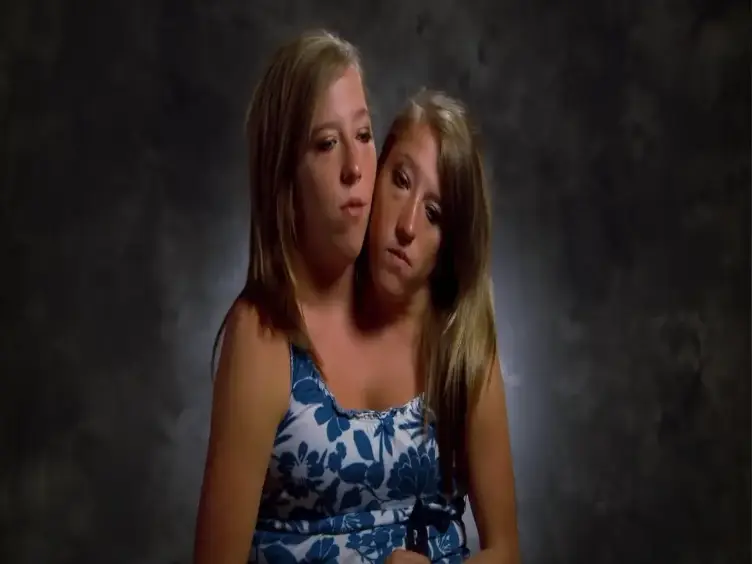Years After These Siamese Twins Were Born, They Have Something To Share
