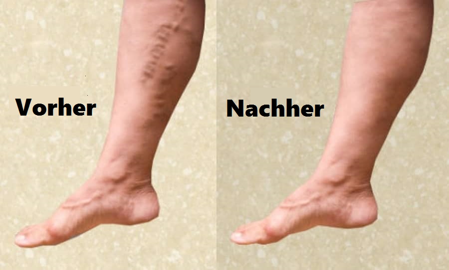 Mit diesem Trick wirst du deine Krampfadern leichter wieder los!