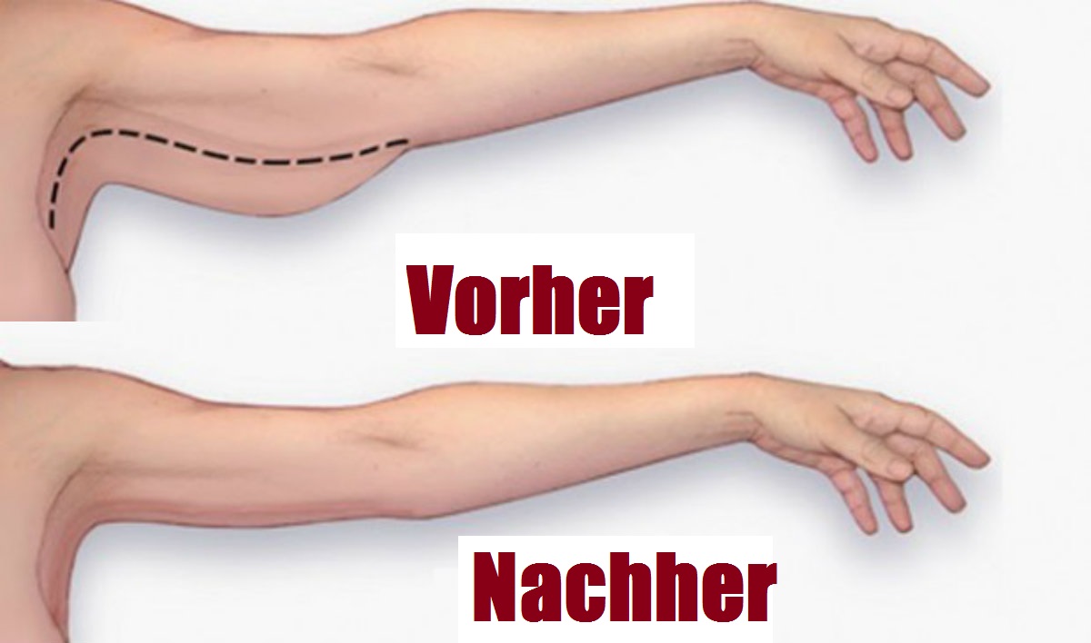Hast du auch 'Schwabbelarme'? Diese 3-Minuten-Übung hilft wirklich.