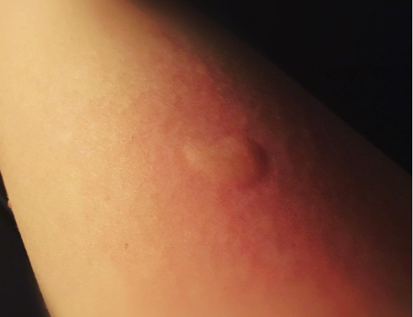Durch die tägliche Einnahme von diesem Vitamin wirst du diesen Sommer NICHT von Mücken gestochen!