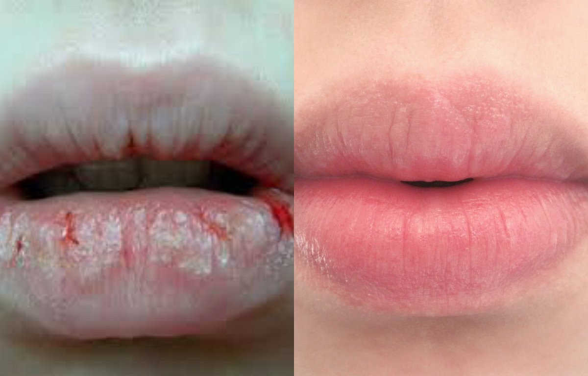 Machen dir trockene, spröde und eingerissene Lippen im Winter auch zu schaffen? DAS ist der Grund!
