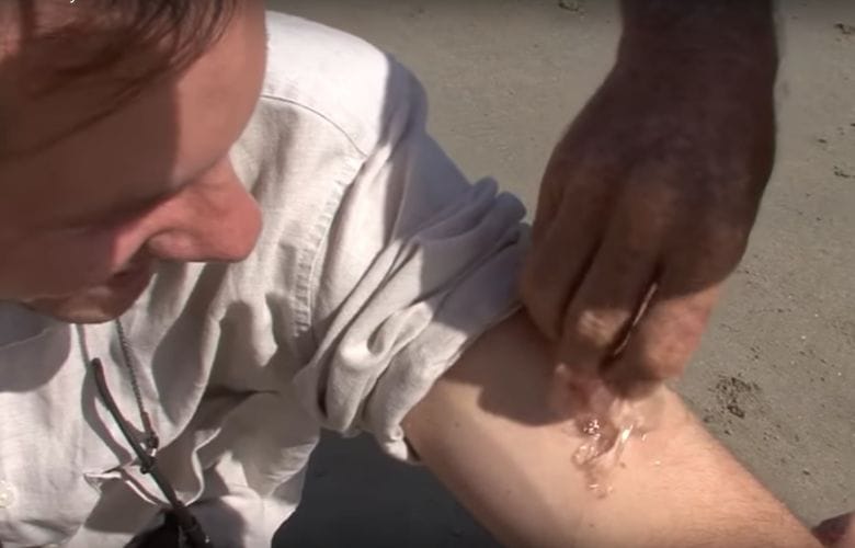 Das musst du tun, wenn du von einer Qualle gestochen wirst