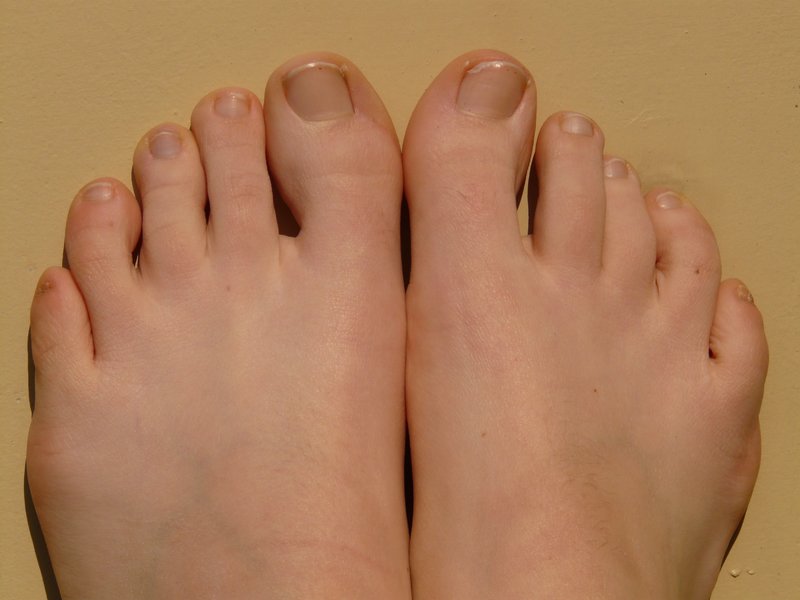 Du brauchst keine teuren Medikamente für Nagelpilz wenn du ihn mit diesem Hausmittel behandelst!
