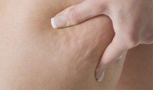 Von DIESEM Kleidungsstück bekommst du viel schneller Cellulitis. Ja, das macht durchaus Sinn...