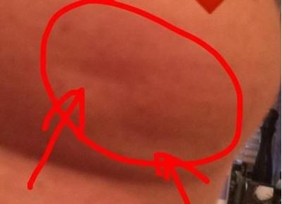 Bitte Teilen: wenig bekanntes Symptom! Mini Delle an der Brust als Brustkrebs erkannt!