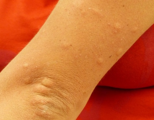 Durch die tägliche Einnahme von diesem Vitamin wirst du diesen Sommer NICHT von Mücken gestochen!