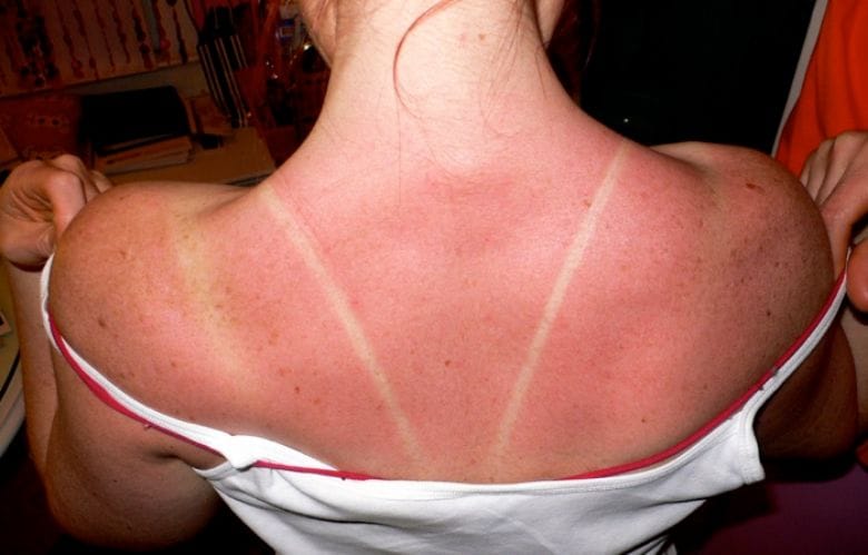 Aus diesem Grund solltest du deine Haut bei einem Sonnenbrand niemals abziehen