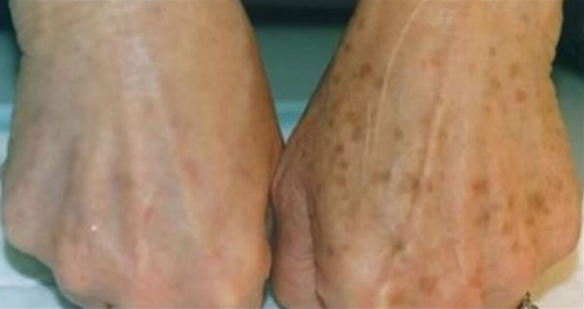 Você tem manchas de idade na sua pele? Com este truque simples elas podem desaparecer!