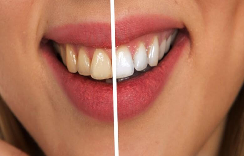 Queste cose possono far ingiallire i denti