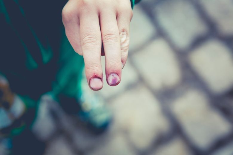 Om deze reden krijgen vrouwen sneller blauwe plekken dan mannen