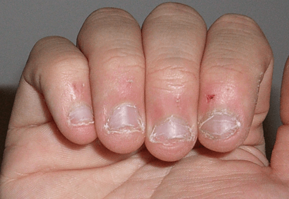 Verslavend maar het ziet er niet uit: nagelbijten! Zo kom je makkelijk van deze nare gewoonte af!
