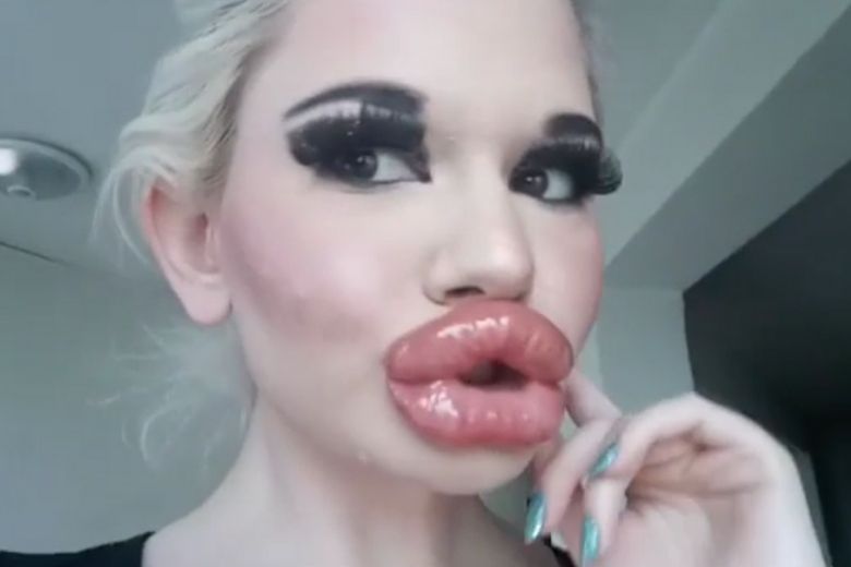 Shocking: jonge vrouw liet lippen twintig keer opspuiten