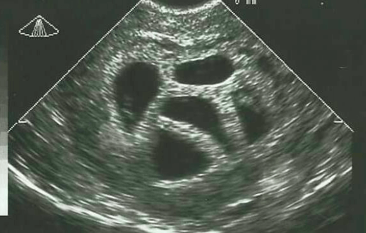 Deze moeder weigerde een abortus van haar vijfling en laat 20 jaar later DEZE foto zien! Wauw!