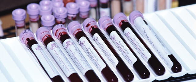 Grote doorbraak in de medische wereld! Er zijn 2 patiënten genezen van HIV en hier lees je hoe.