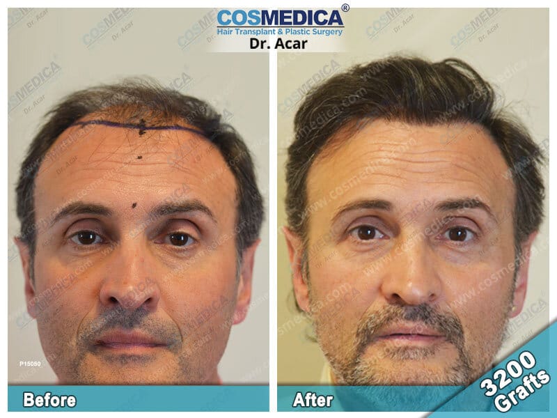 haartransplantatie cosmedica