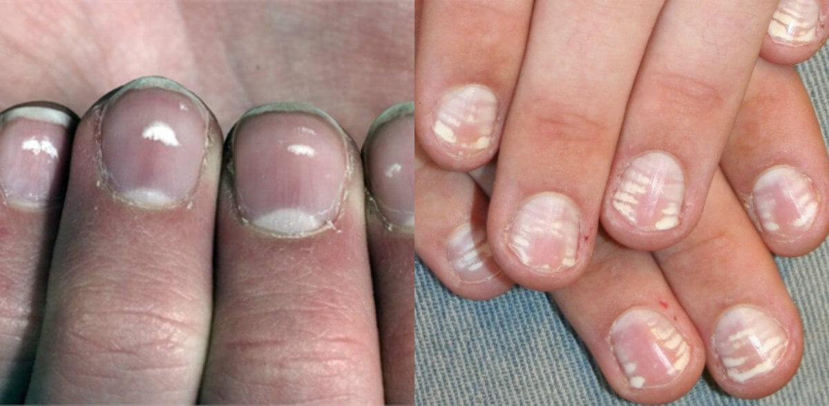 Wist jij al waar die witte vlekjes op je nagels vandaan komen? Wij nu wel!