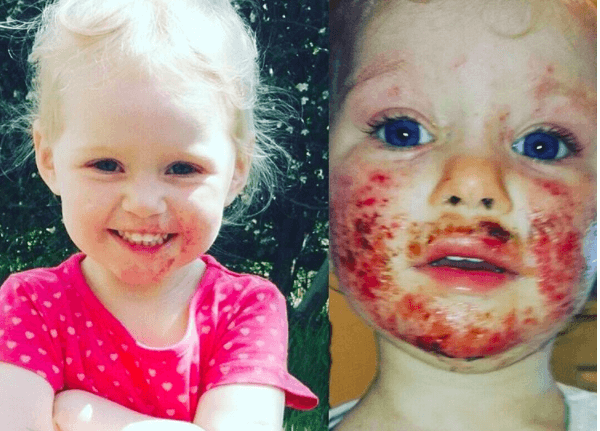Wat afschuwelijk dit... een familielid met herpes verwoestte het gezicht van 3-jarige Sienna!
