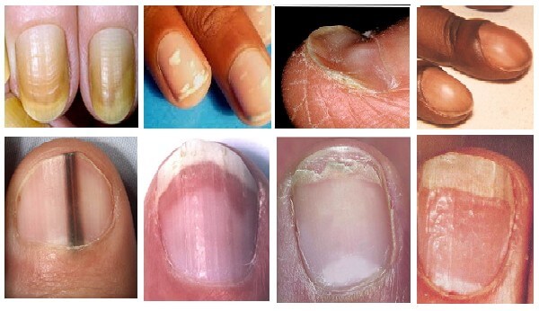 Zie je DEZE kleur op je nagels? Schakel dan hulp in, want het zou hele nare gevolgen kunnen hebben!
