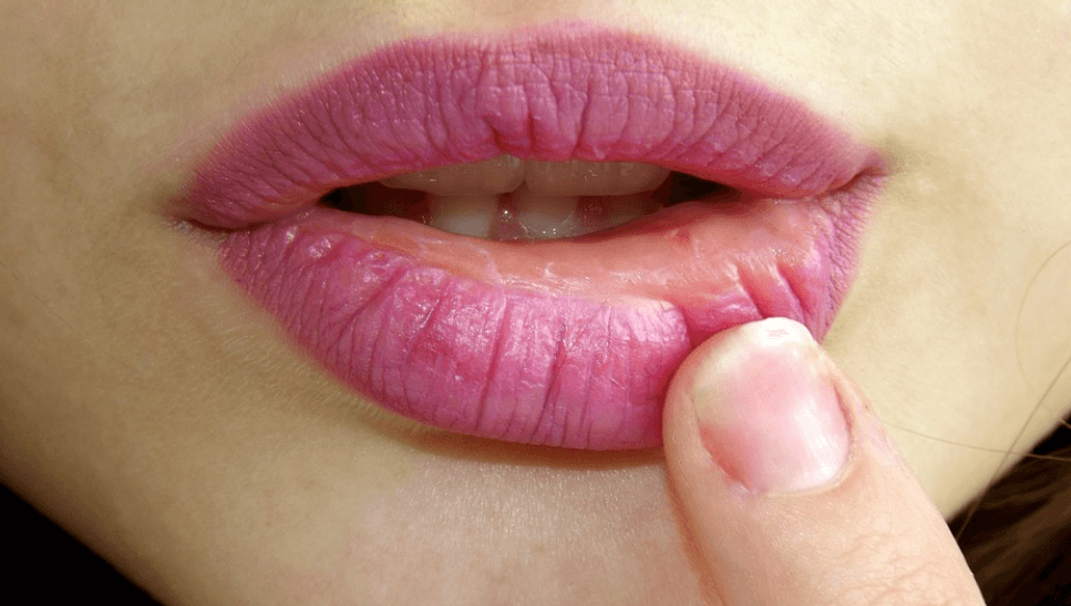 Heb jij ook altijd zo'n last van droge, gebarsten lippen in de winter? HIER komt het door!