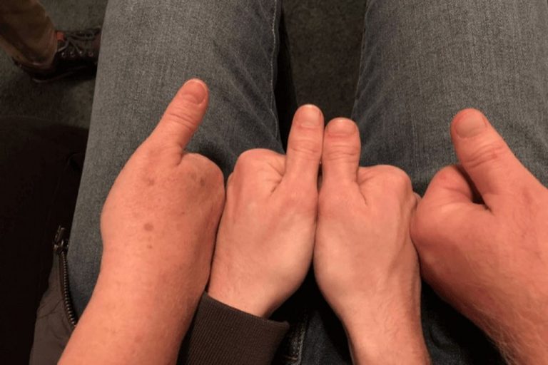 20 Mensen Met Unieke Genetische Eigenschappen Die Je Niet Snel Vergeet