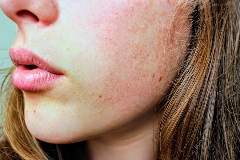 Deze 5 huidproblemen wijzen op een vitamine D-tekort