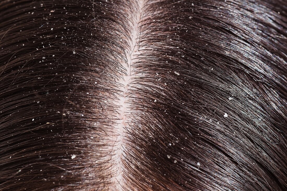 Heb jij last van roos? Dan moet je DIT natuurlijke middeltje eens proberen! Werkt beter dan anti roosshampoo!