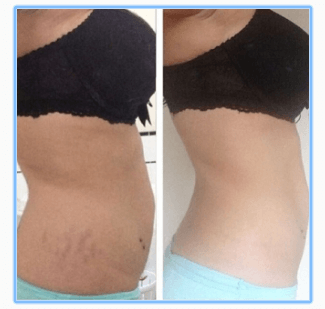 Wauw, je hebt maar één product nodig om van je cellulite af te komen!! Dit moet je zeker eens proberen!