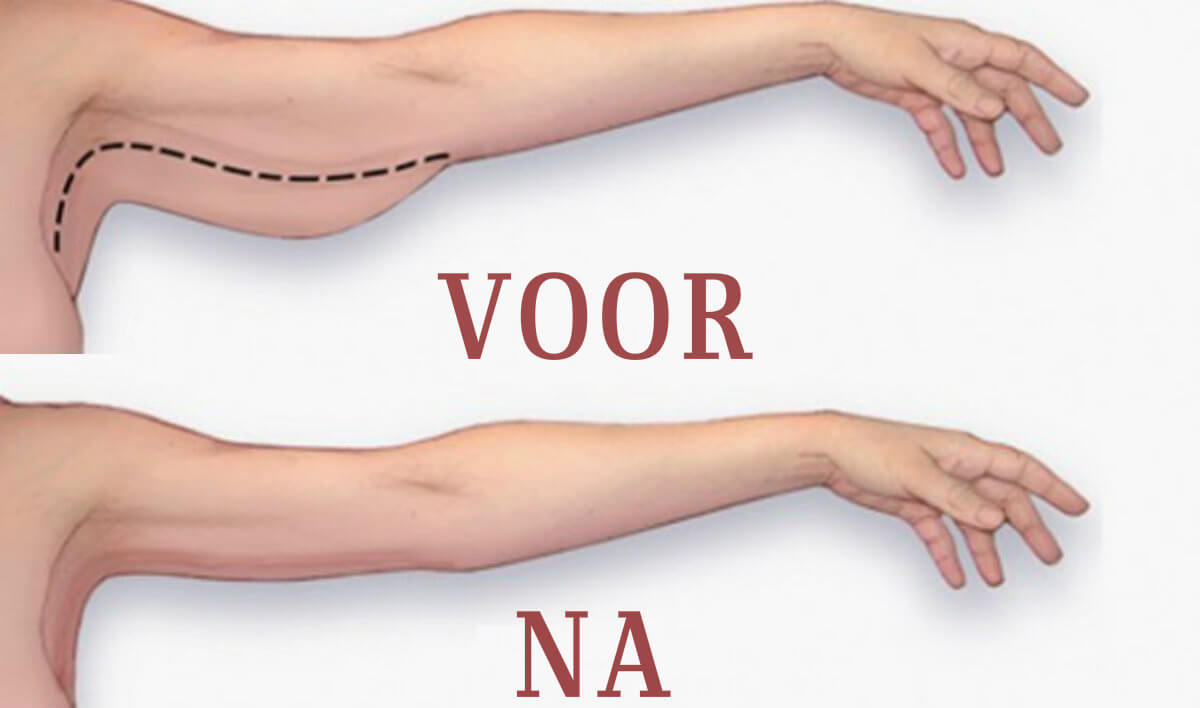 Last van armvet? Met deze oefening van maar DRIE minuten ben je er zo vanaf! Dit moet je doen!