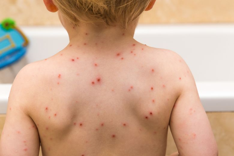 Apenpokkenvirus voor het eerst vastgesteld bij een kind in Nederland