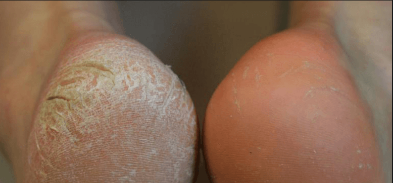 WOW! Dit gebeurt er als je een snee brood rond je voet bindt! Deze tip MOET je zien!