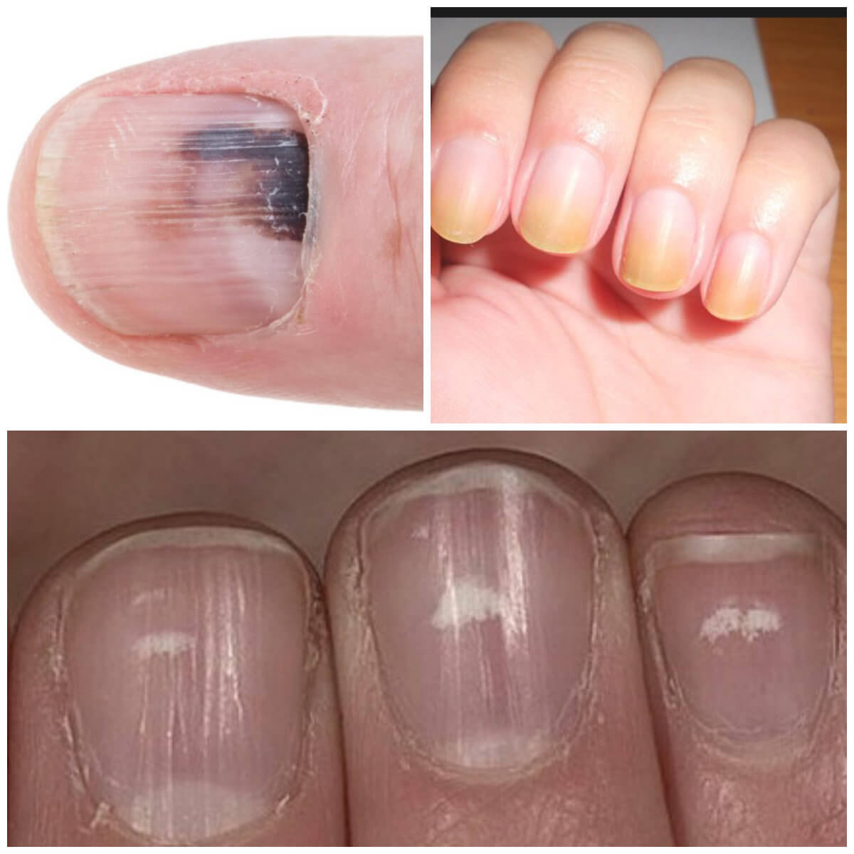 Witte lijnen, gele nagels of donkere plekken? Dit zeggen je nagels over jouw gezondheid!