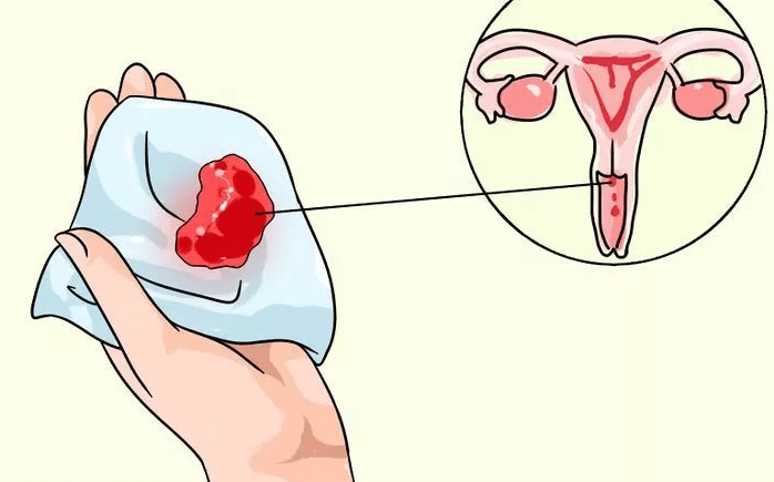 Hoe merk je dat je baarmoederhalskanker hebt? DIT zijn de symptomen waar je op moet letten!