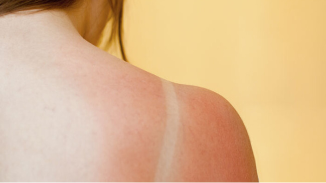 Een verbrande huid door de zon
