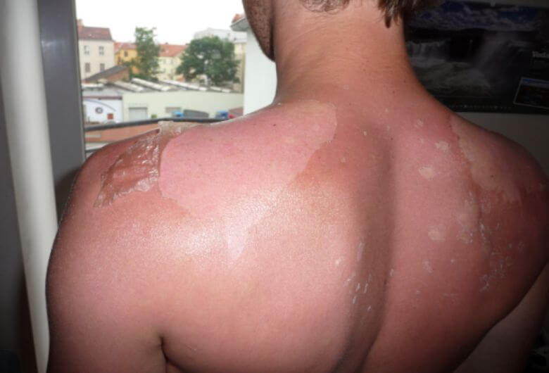 Dit is de reden waarom je nooit velletjes van een verbrande huid moet trekken