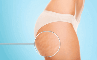 Een groot deel van de bevolking heeft last van cellulitis. Hoe kom je er van af? We hebben een trucje!